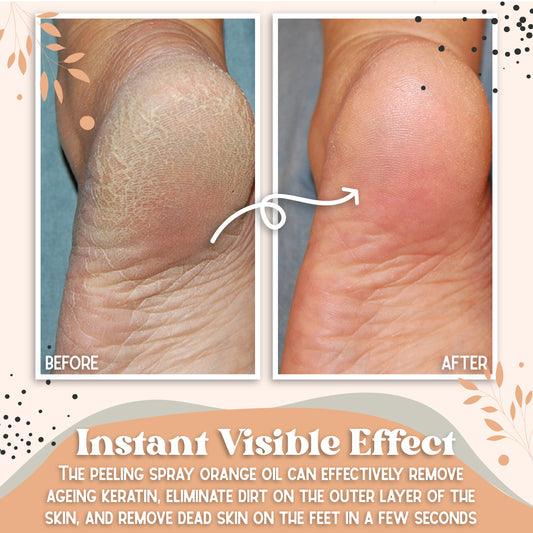 FootRevive™ Callus Removal Spray