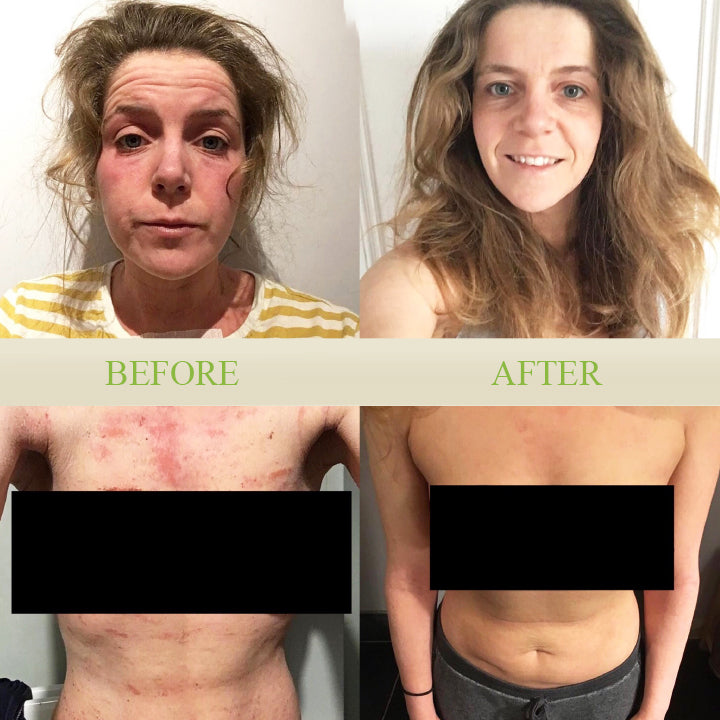 TineaCure™ Antifungal Cream