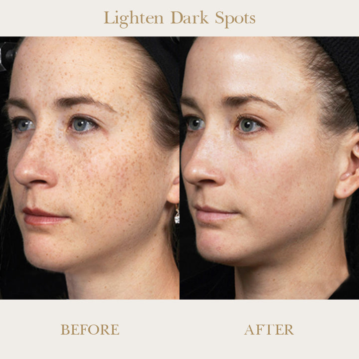 SkinRenew™ Spot Refining Serum