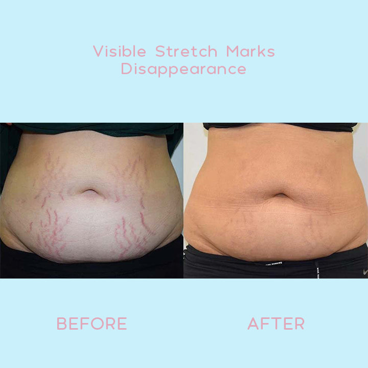 ELASTIN™ Anti-Stretch Mark Cream