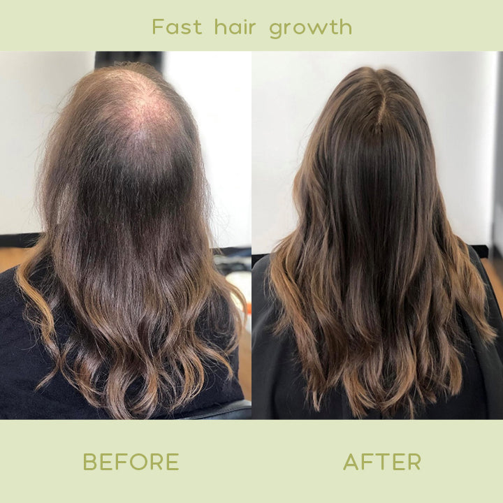 RegrowPlus™ Hair Nourishing Ginger Spray