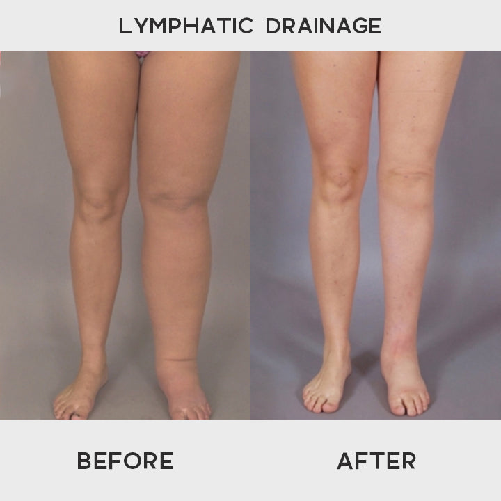 Lymphvity™ Lymphatic Thermotherapeutic Ring