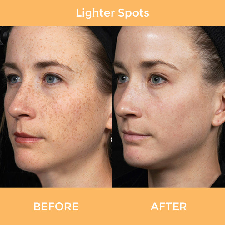 Spot-OFF™ Dark Spot Corrector Serum