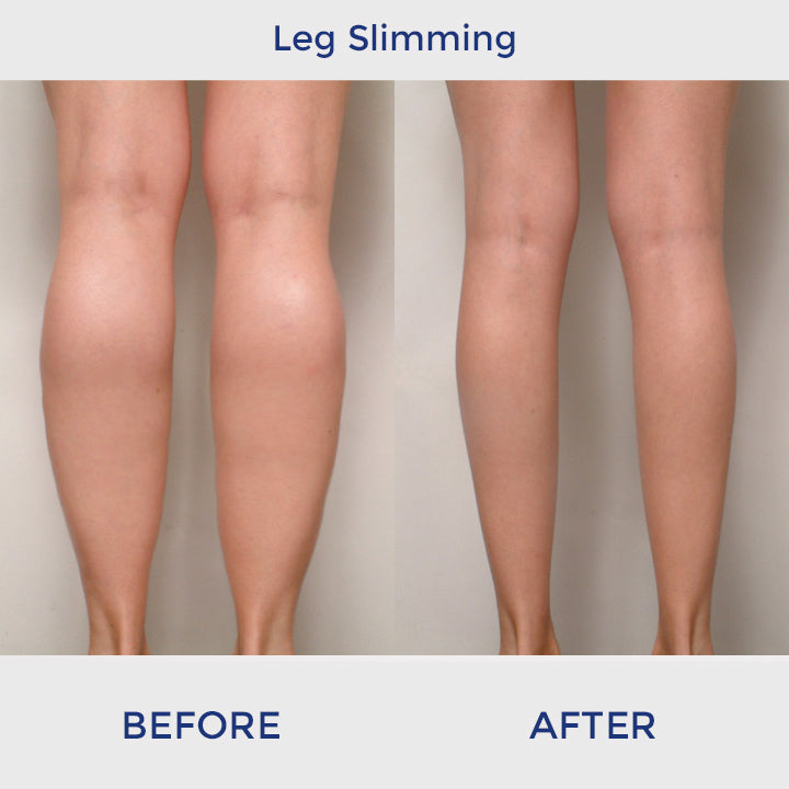 ShapeUp™ Slimming Waist Patch