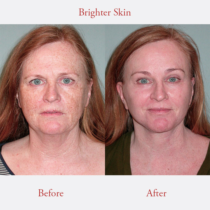 CLARITY™ Freckle Whitening Cream
