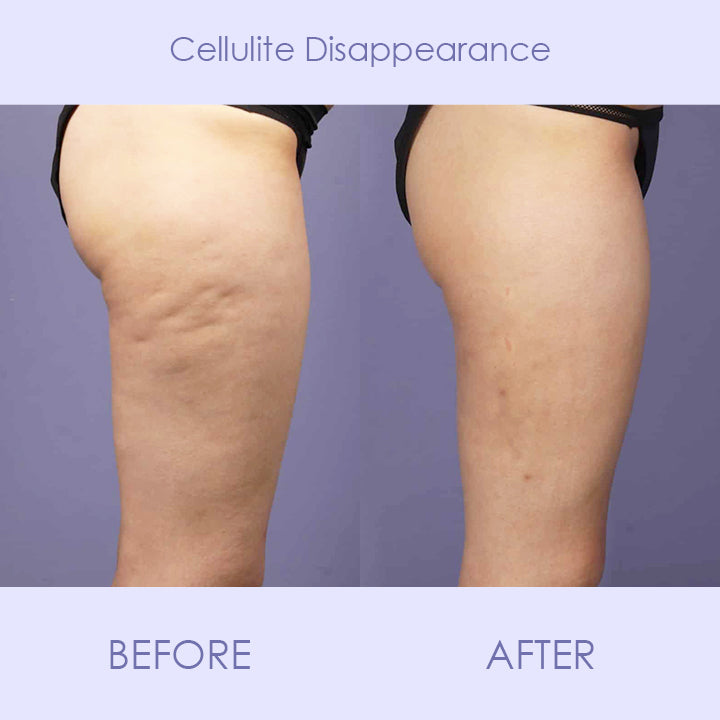 Beautify™ Anti-Cellulite Tightening Patch
