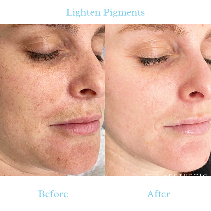 Nlurad™ Dark Spot And Acne Treatment Lotion