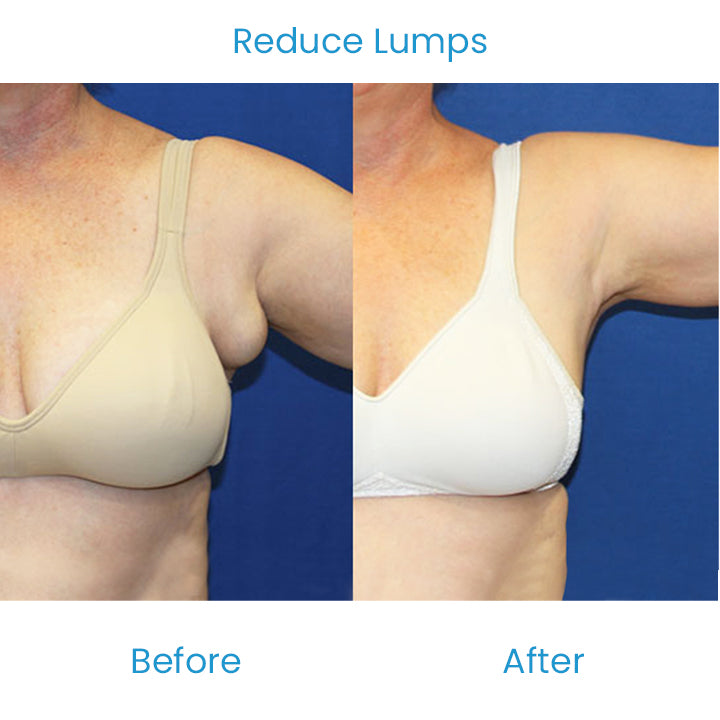 LumpFree Lipoma Removal Cream