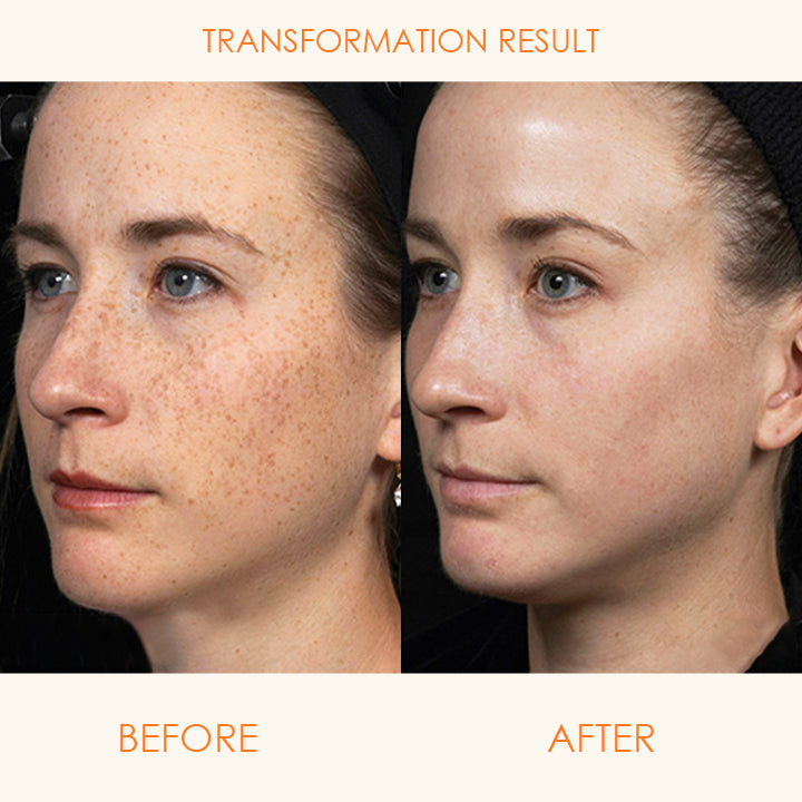 SkinRenew™ Blemish Corrector Serum