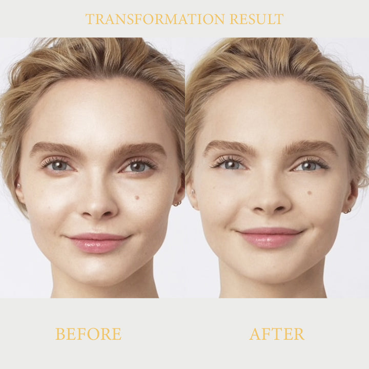 EyeLift™ Ionic Contouring System