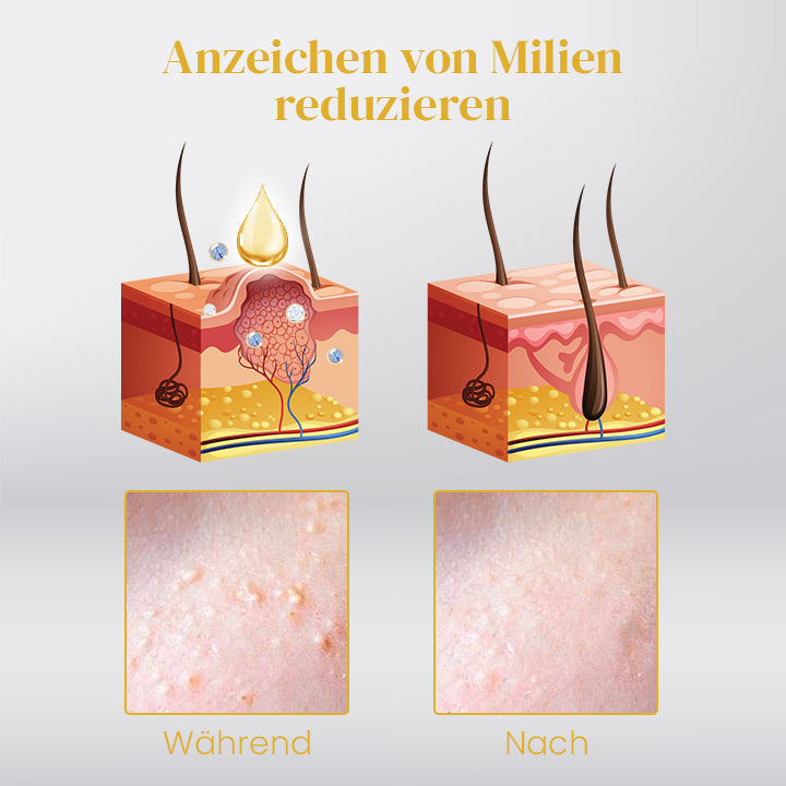 Ceoerty™ Behandlung zur Entfernung von Milien