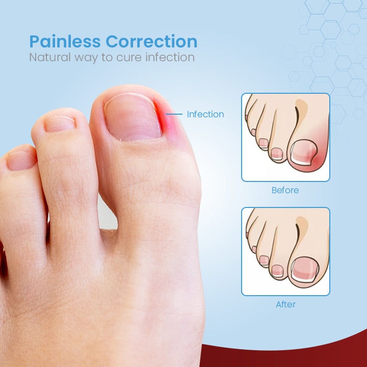 ToenailPro™ German Paronychia Relief Patch