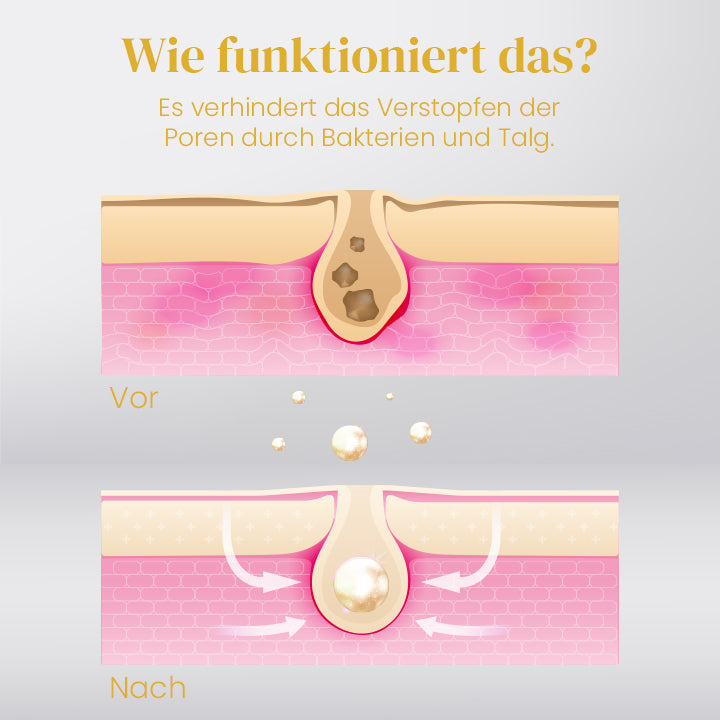 Ceoerty™ Behandlung zur Entfernung von Milien