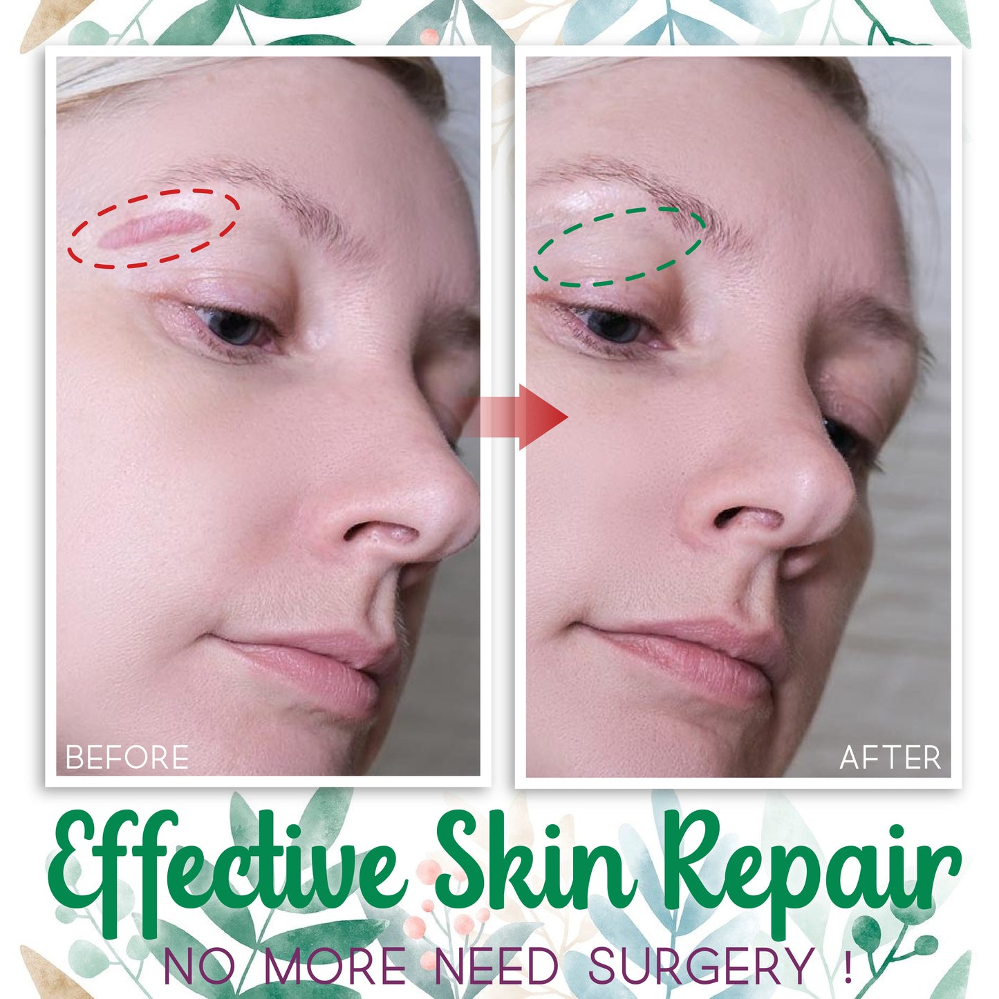InvisiScar Skin Renewal Cream
