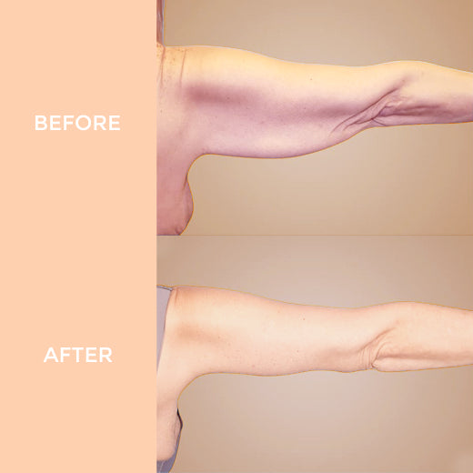 Arm Slimming Essential Oil