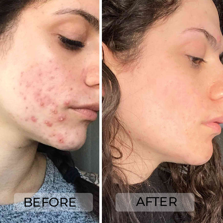 Anti Acne Body Spray