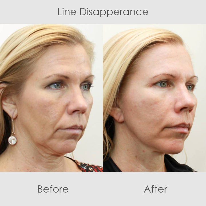 ChaffeeLife™ Wrinkle Reversing Botox Serum