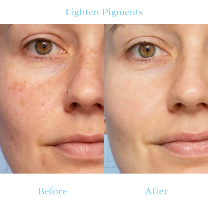 Nlurad™ Dark Spot And Acne Treatment Lotion