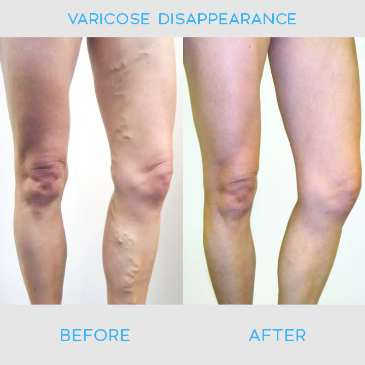 VeinDefense™ Varicose Treatment Spray