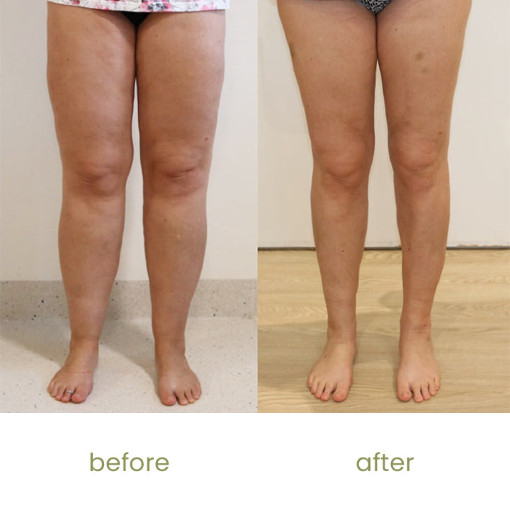 SizSlim™ Leg Slimming Herbal Patch