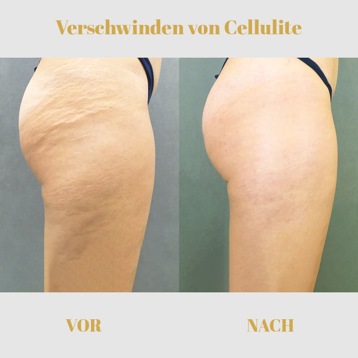PeachyBum™ Hüftstraffendes Ätherisches Öl