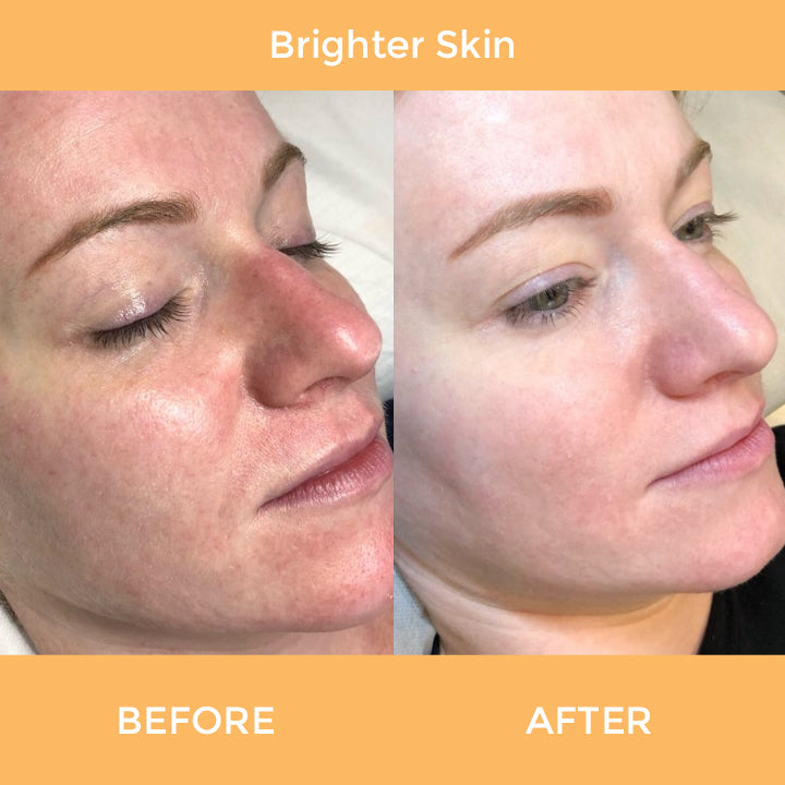 Spot-OFF™ Dark Spot Corrector Serum