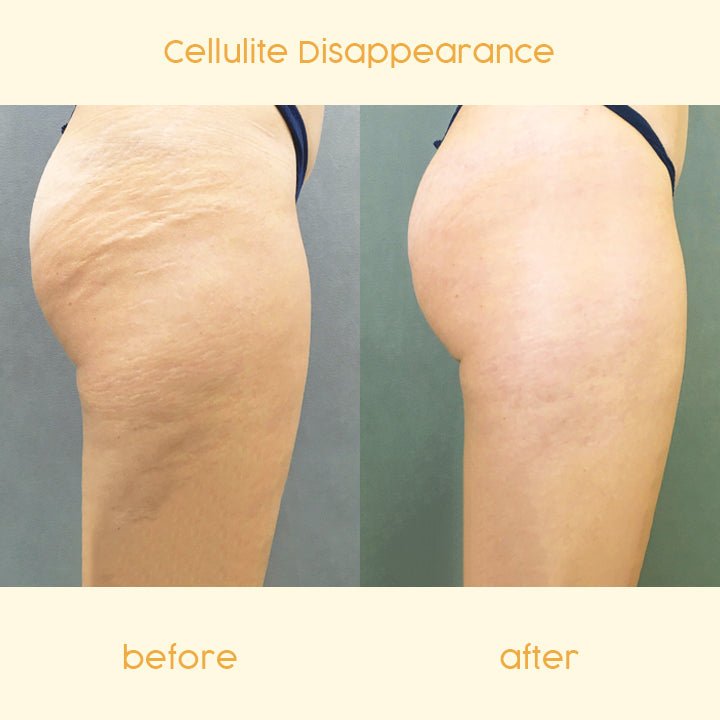CELLUFIGHT™ Anti-Cellulite Slimming Cream