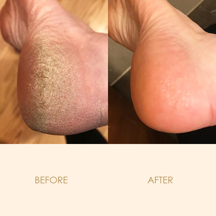 FungiCure™ Intensive Anti-Fungal Spray