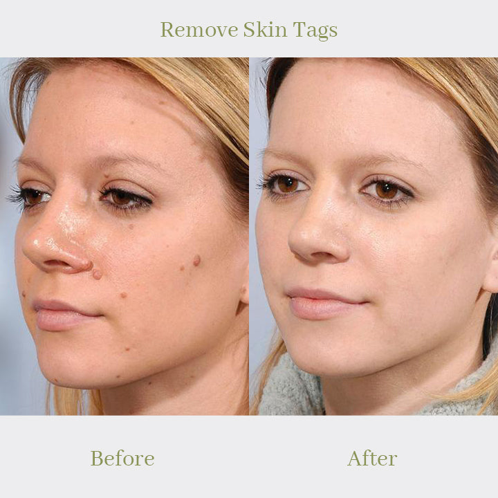 ProTag™ Skin Tag Remover Patches
