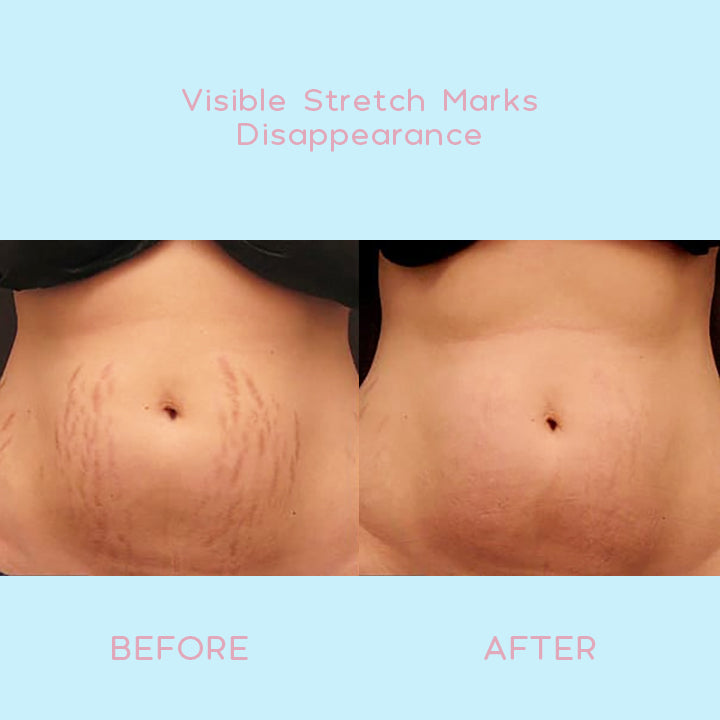 ELASTIN™ Anti-Stretch Mark Cream