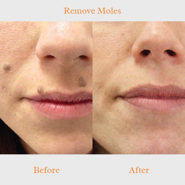TruSkin™ Blemish Remover Serum
