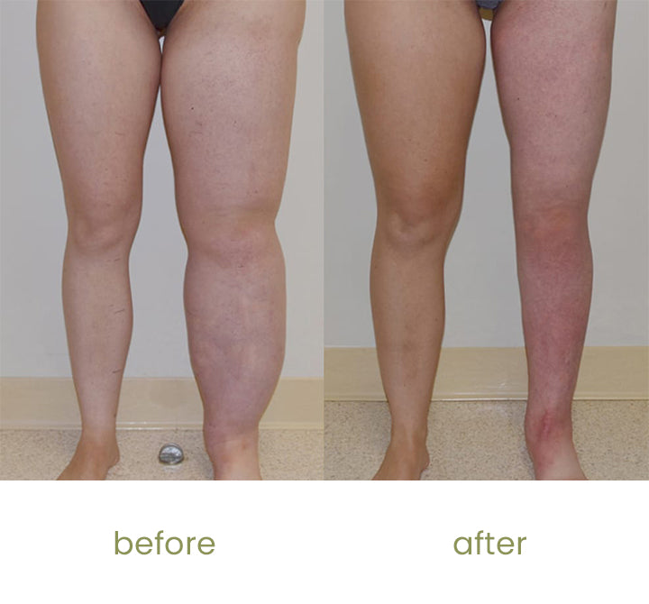 SizSlim™ Leg Slimming Herbal Patch