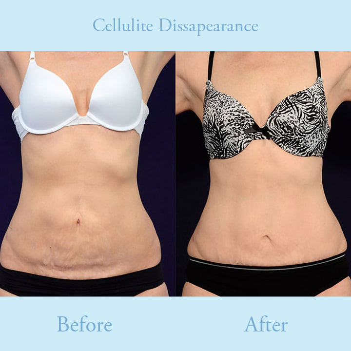 ProFirm Skin Tightening Spray