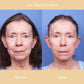 Regenerist™ Anti-Wrinkle and Moisturizing Essence