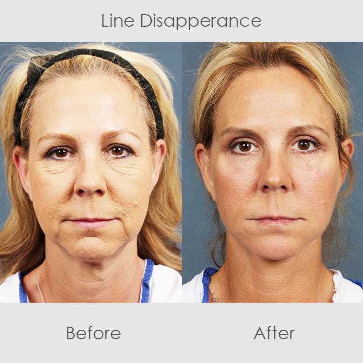 ChaffeeLife™ Wrinkle Reversing Botox Serum