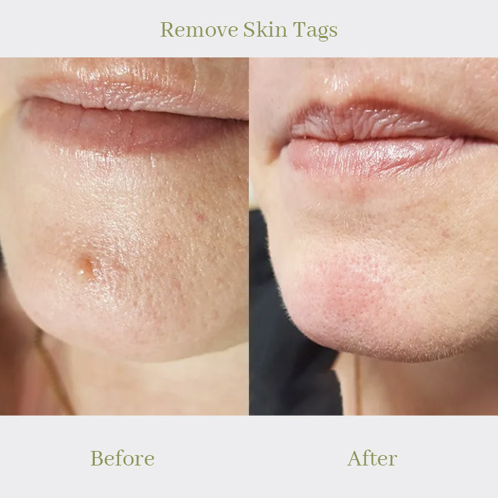 ProTag™ Skin Tag Remover Patches