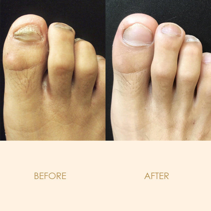 FungiCure™ Intensive Anti-Fungal Spray