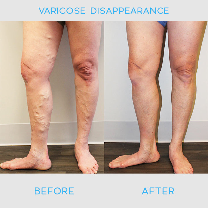 VeinDefense™ Varicose Treatment Spray