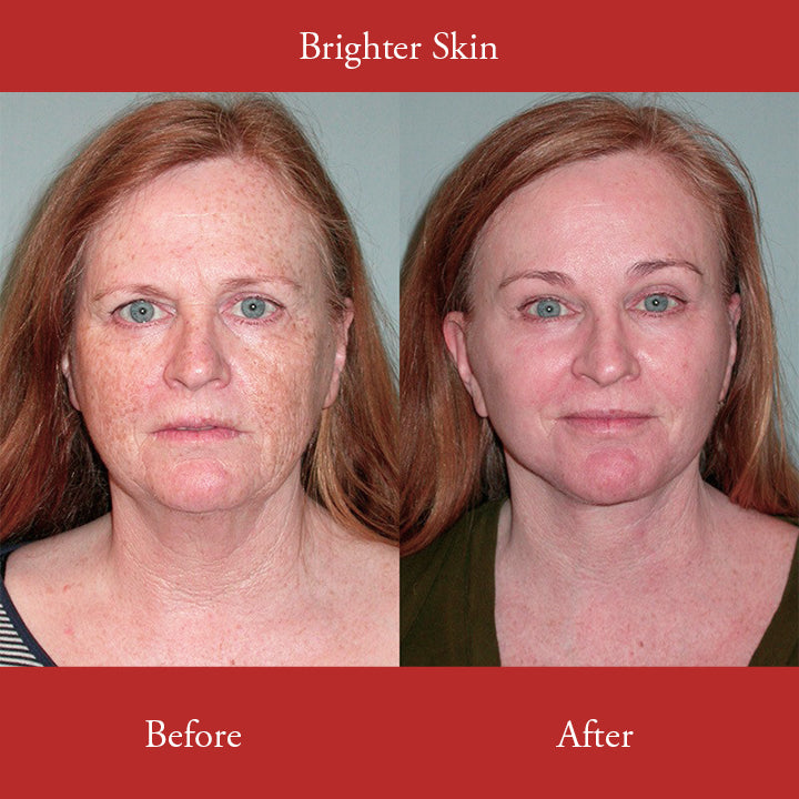 LUMINATE™ Freckle Whitening Cream