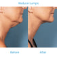 LumpFree Lipoma Removal Cream