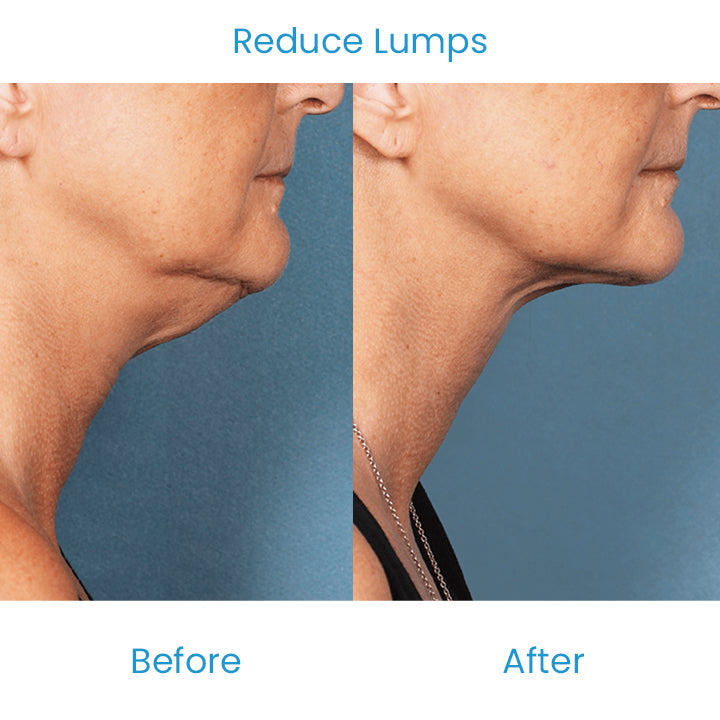 LumpFree Lipoma Removal Cream