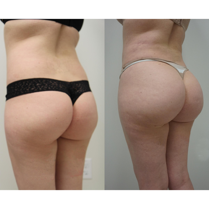 Butt Lifting Shaping Patch