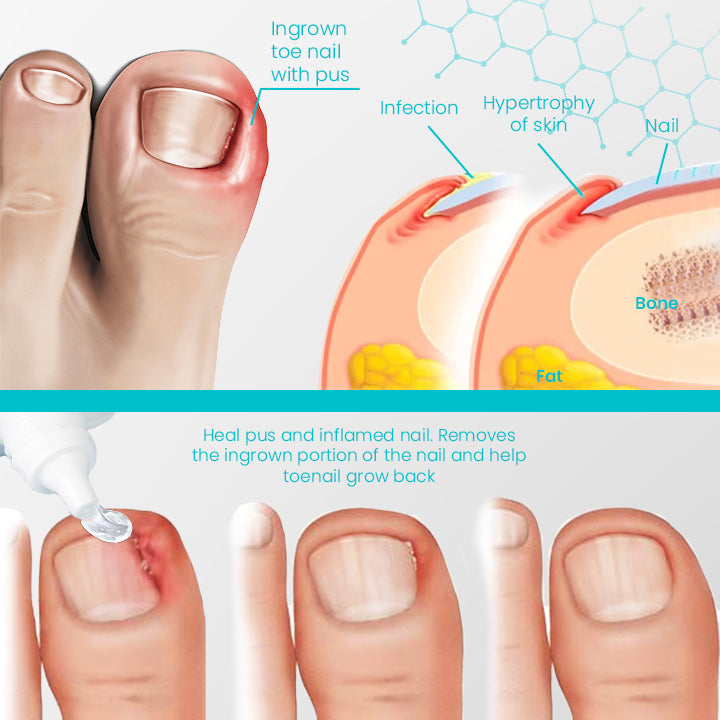 NailRevive™ Psoriasis Recovery Gel