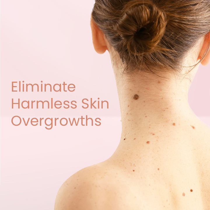 Herbal Wart Skin Removal Ointment