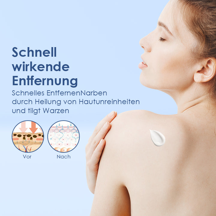 WartsOff Creme zur sofortigen Entfernung von Hautunreinheiten