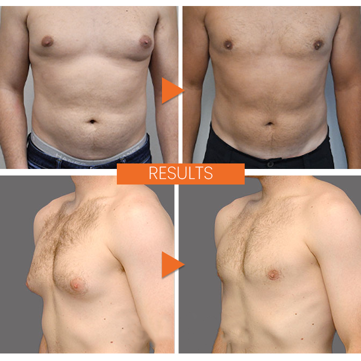 FitPlus™ Anti-Gynecomastia Spray