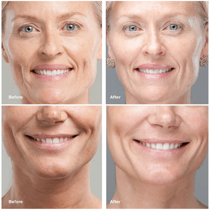 INSTALIFT™ Protein Threading Set