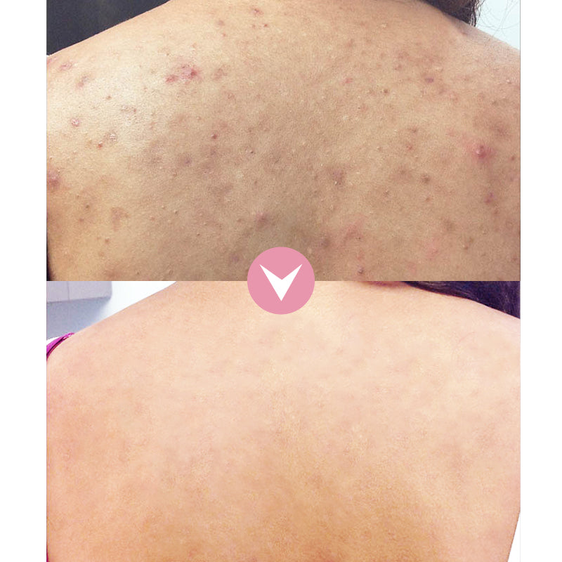 Pure AHA + BHA Treatment Serum