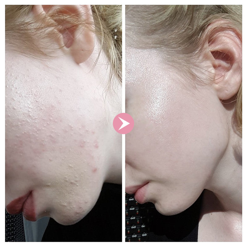 Pure AHA + BHA Treatment Serum