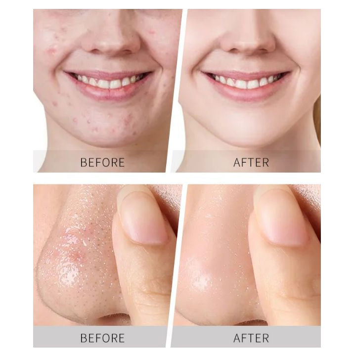 PoreKiller™ Volcanic Clay Mask